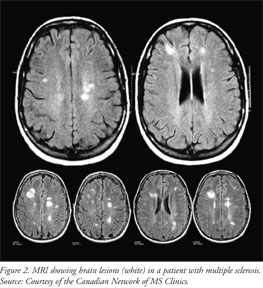 MRI showing brain lesions