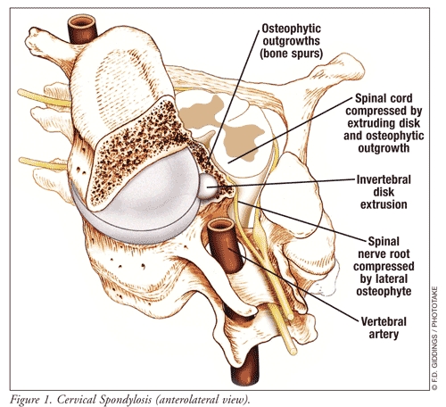 Cervical Spondylitis Neck Symptoms