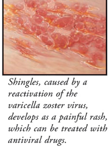 can antivirals make shingles worse