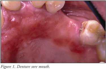 Treatment Of Common Oral Lesions