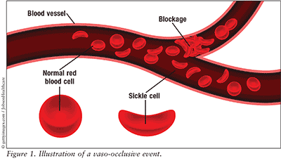 Image result for sickle cell anemia