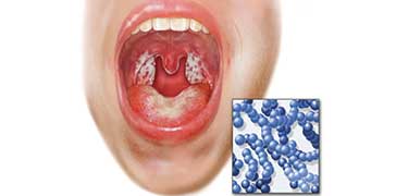 streptococcus throat