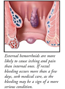 Causes of anal b leeding